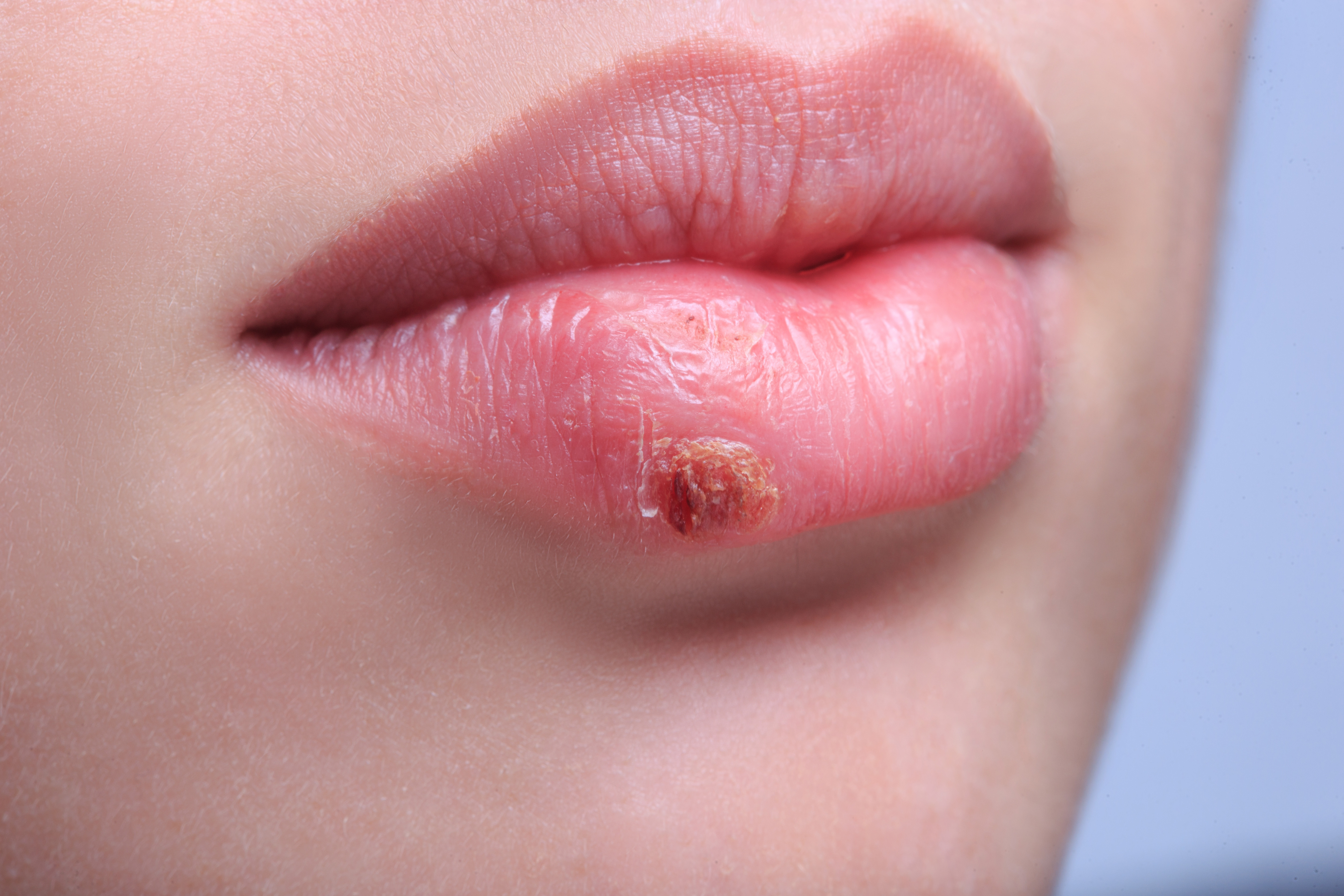 Rid to herpes natural ways get of How to