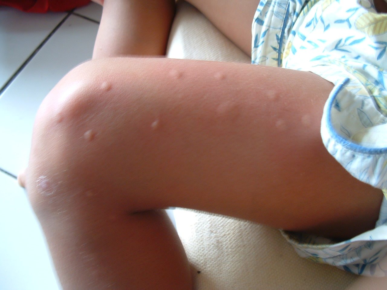 mosquito bite photo