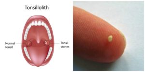 Tonsil stones in mouth illustration and stone on finger