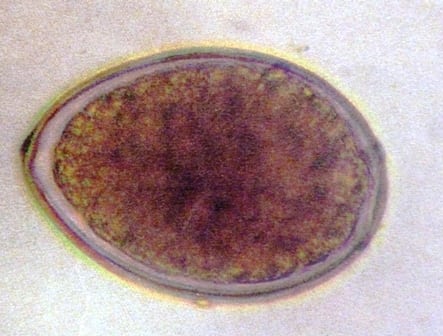 Diphyllobothrium Infection photo