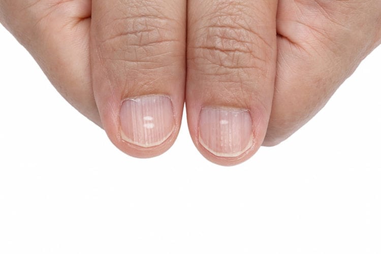White spots and Vertical ridges on the fingernails 