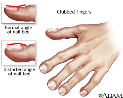 Illustration shows fingernail clubbing