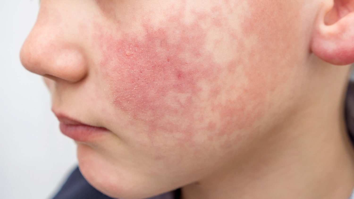 spontan svulst Generalife Red cheeks on children could be a sign of a virus