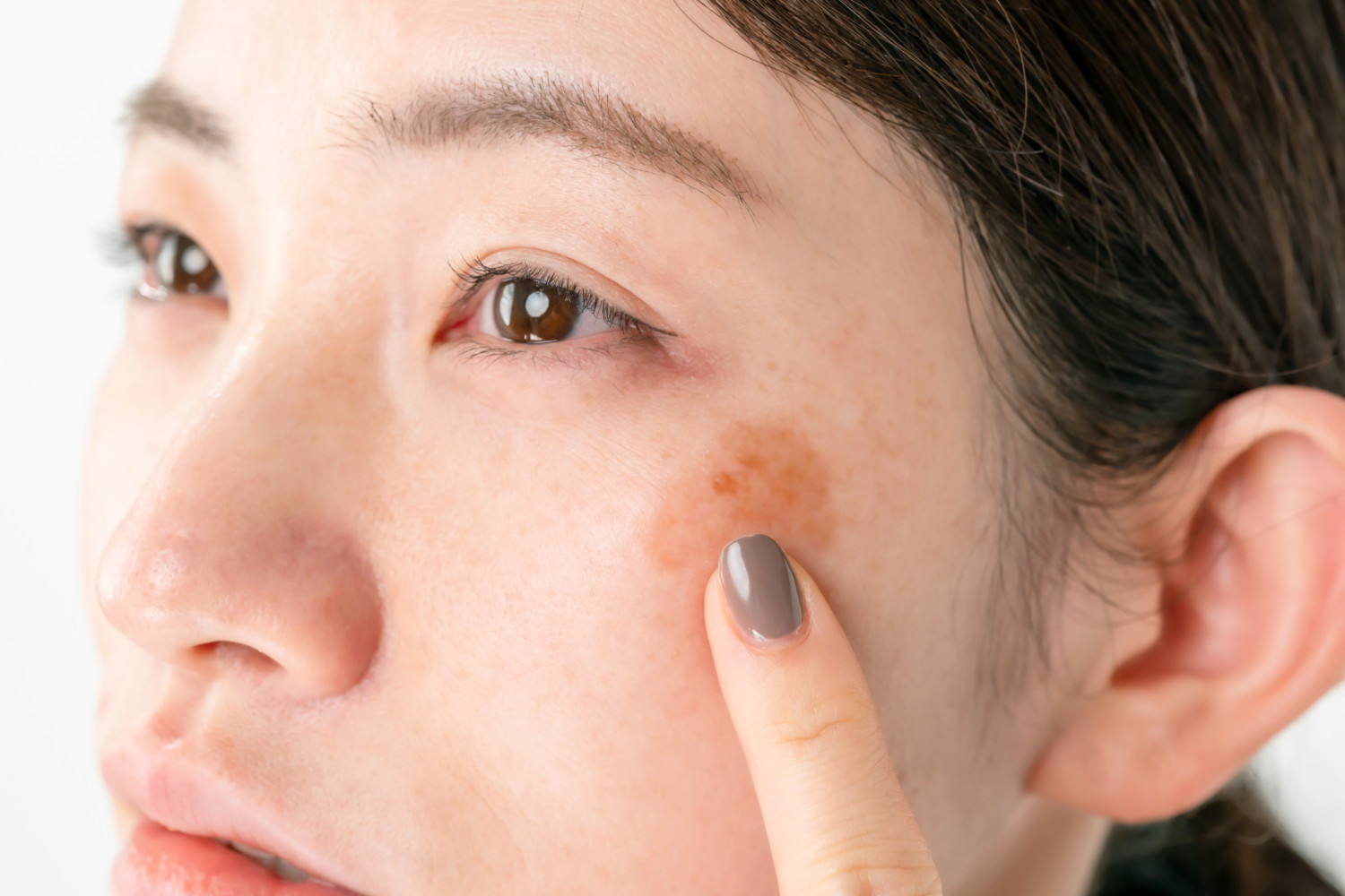 Woman points to hyperpigmentation on face