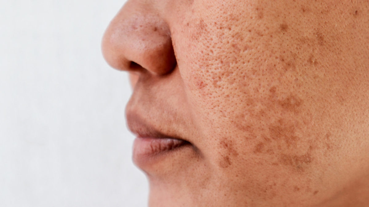 A woman is shown with dark spots and blemish marks on her cheek.